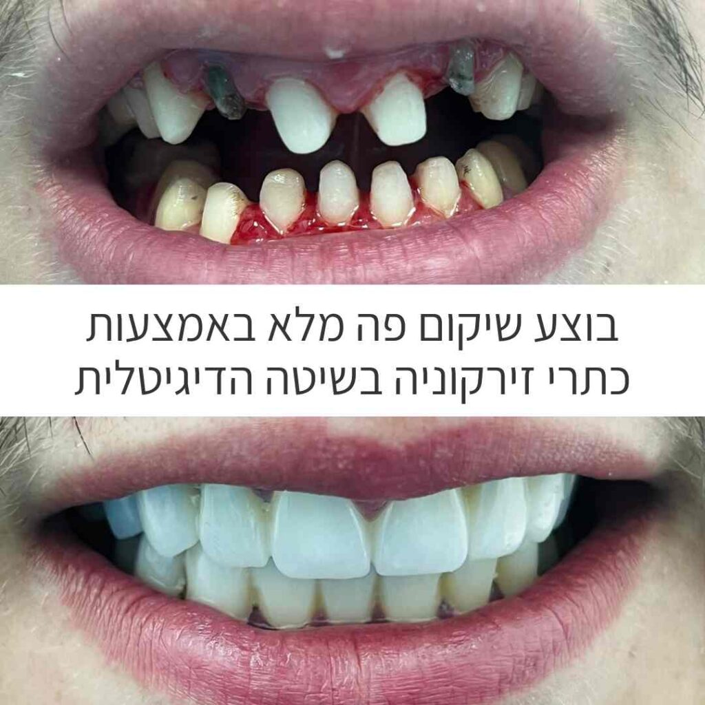 כתרי זירקוניה לפני ואחרי