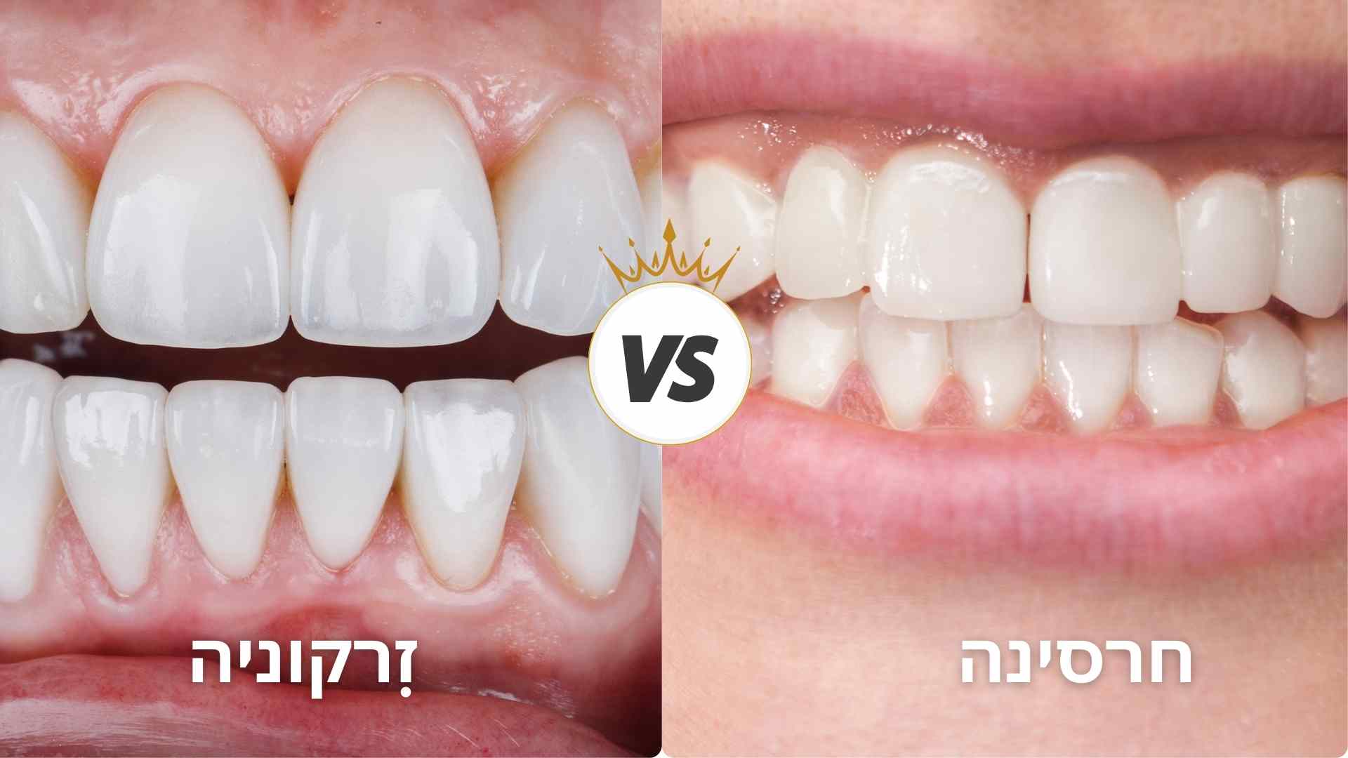 הבדל בין כתר זירקוניה לחרסינה