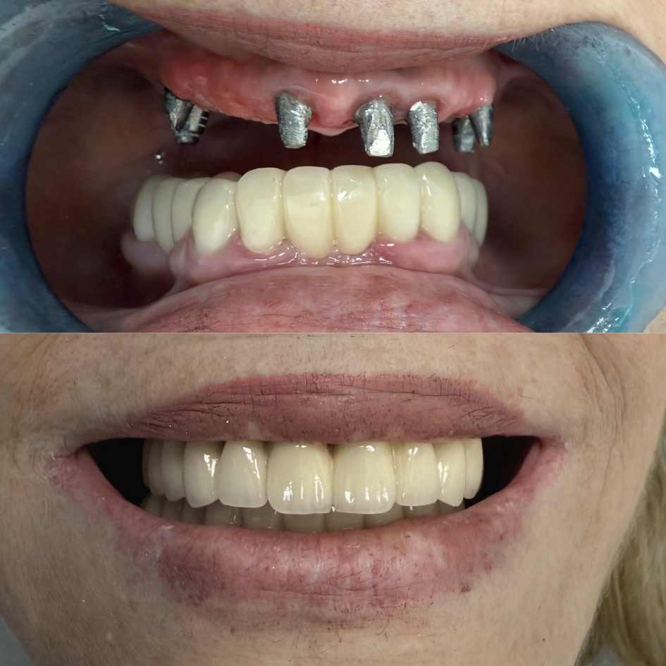 השתלת שיניים פני אחרי