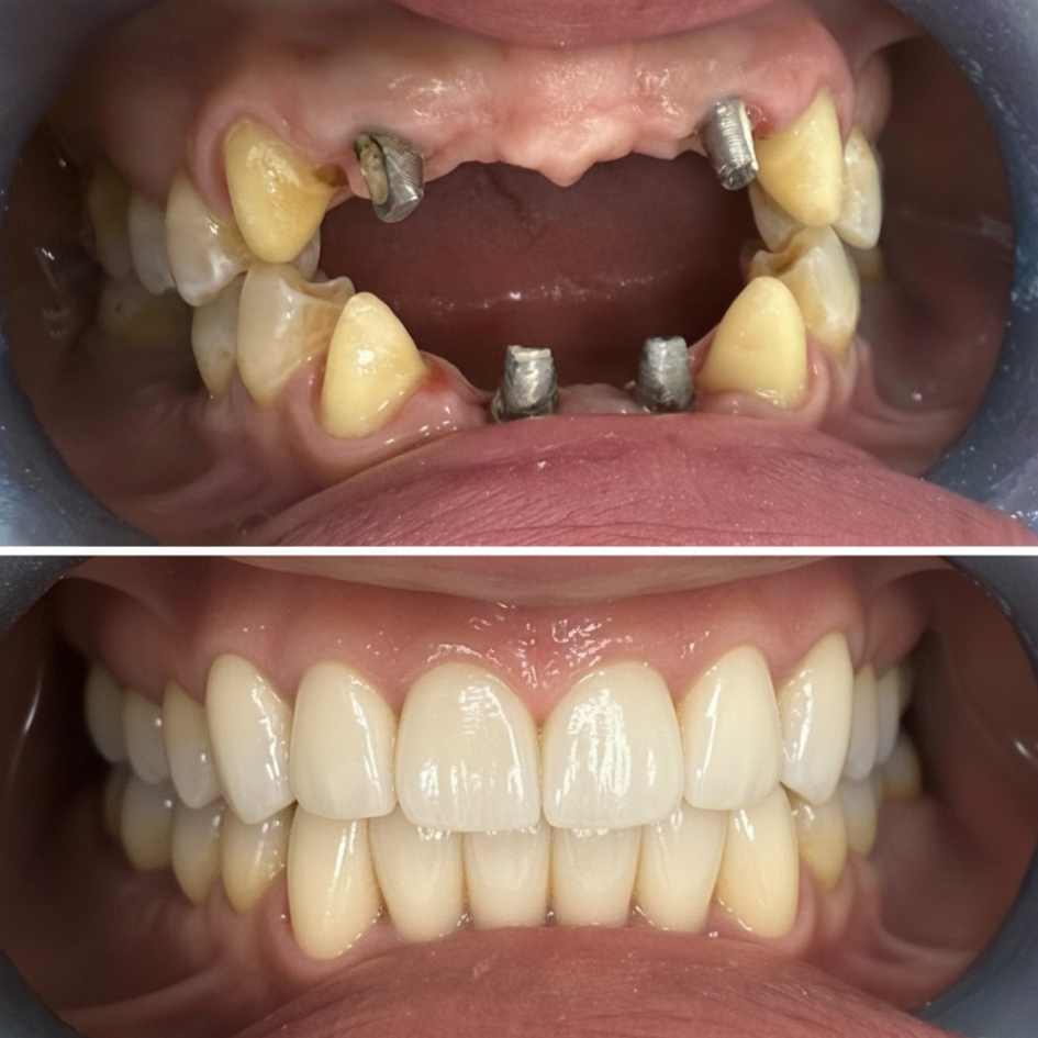 השתלת שיניים פני אחרי