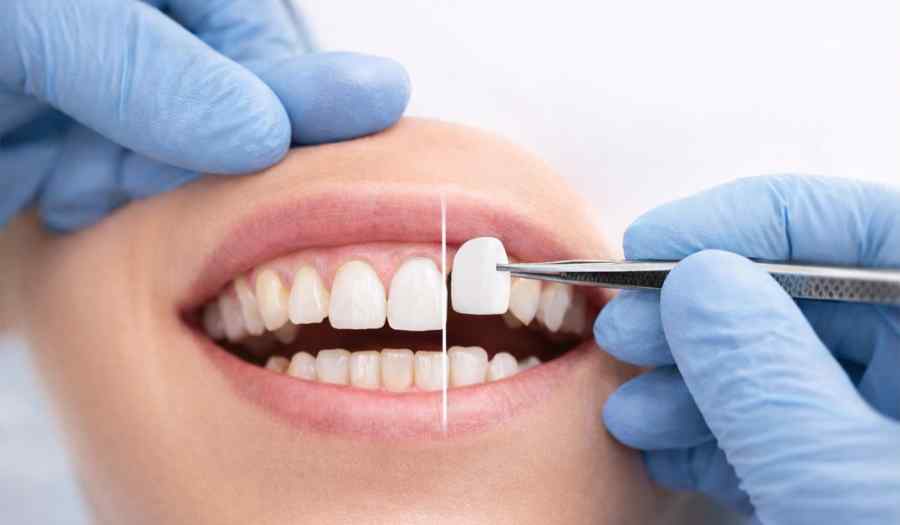 ציפויי חרסינה: הלחיך הטיפול וכמה עולים ציפויי שיניים מחרסינה