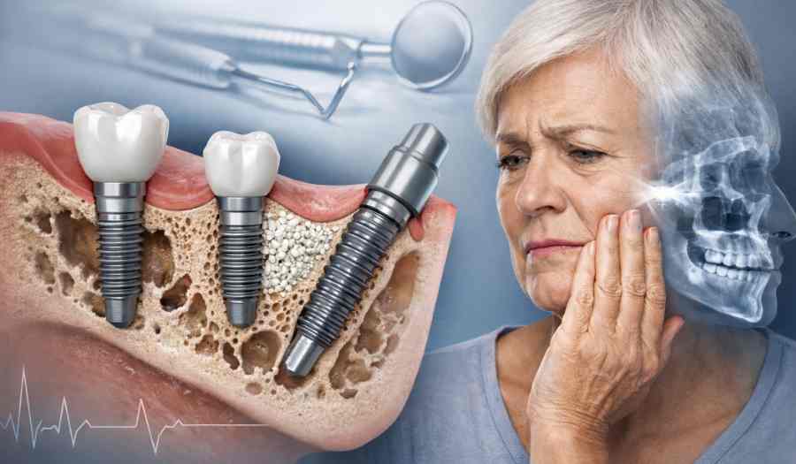 השתלות שיניים במצב של עצם חלשה